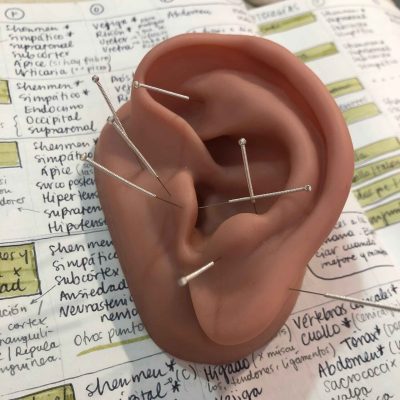 Accupuncture Accupuncture